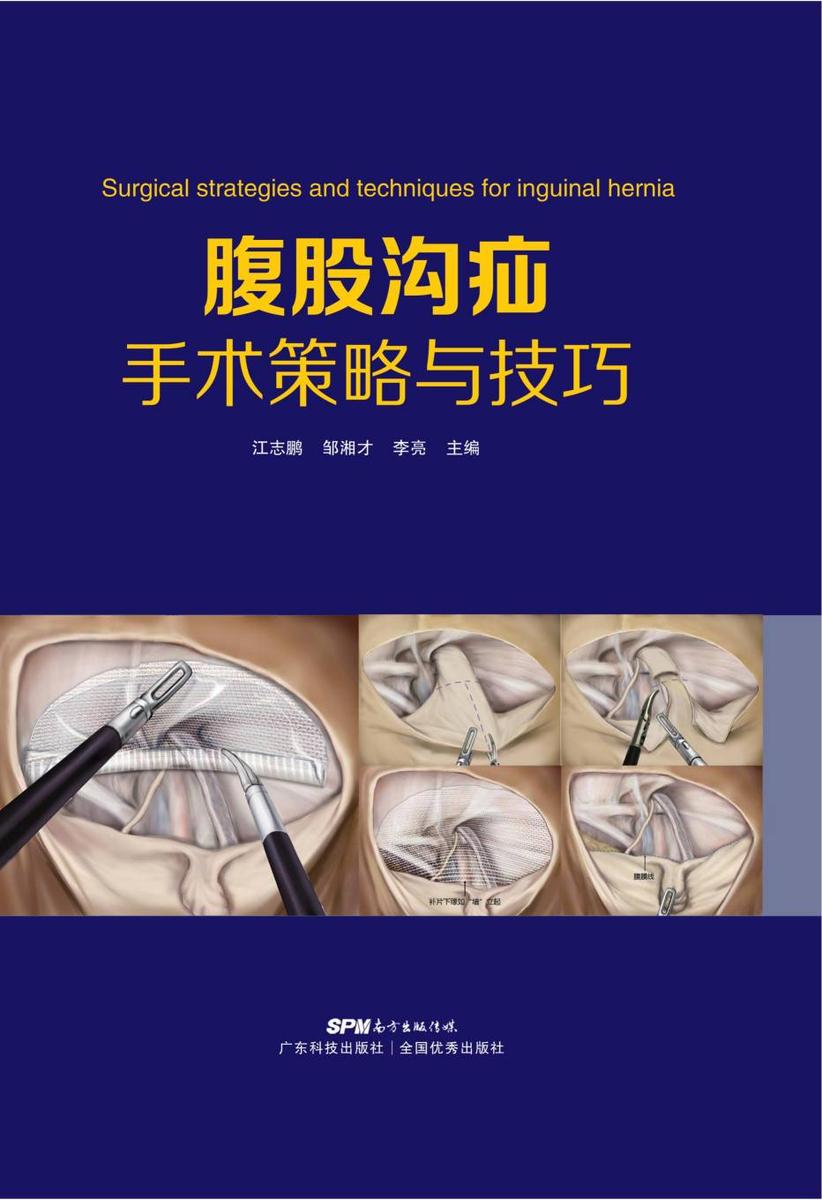 腹股沟疝手术策略与技巧