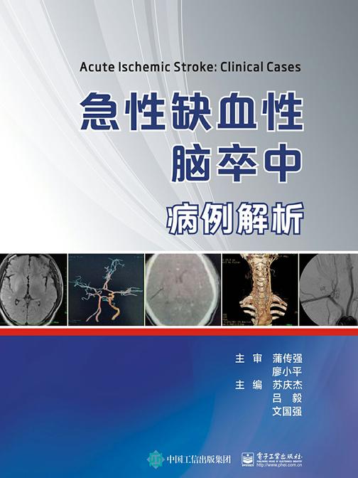急性缺血性脑卒中病例解析
