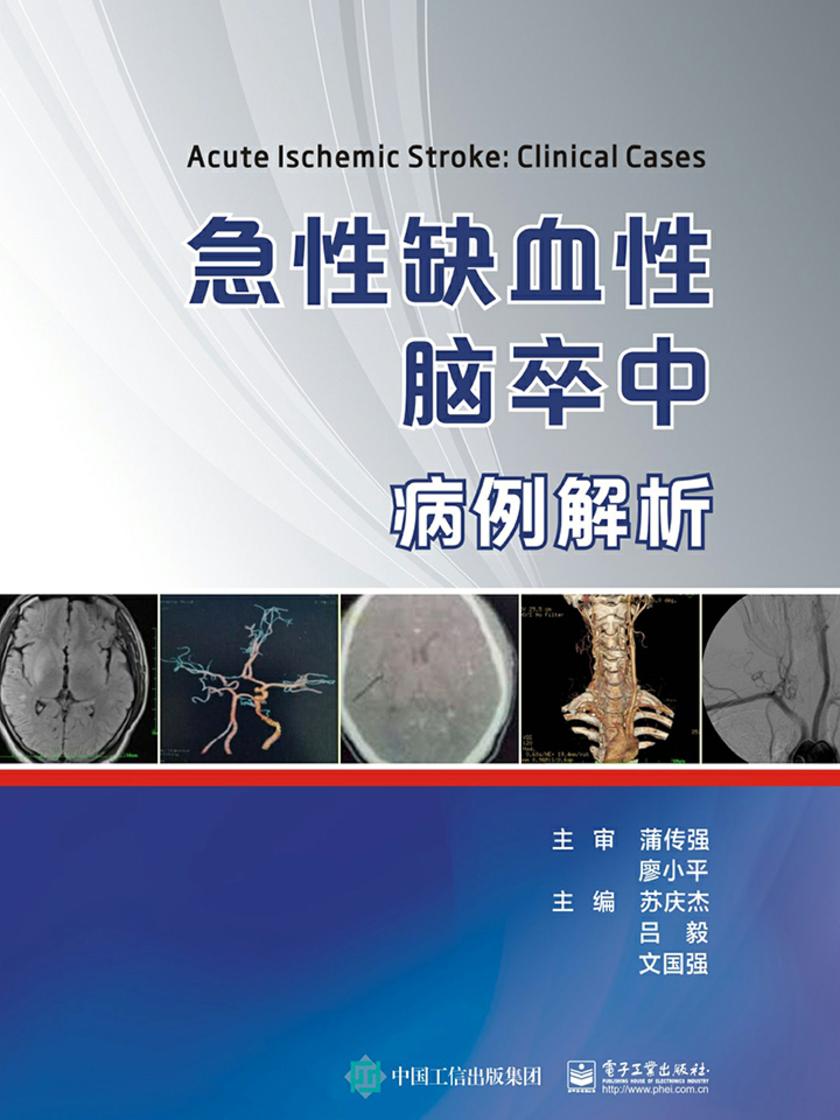 急性缺血性脑卒中病例解析
